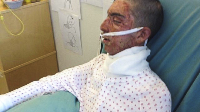 Shayan ligger i sykehusseng med brannskader i ansiktet