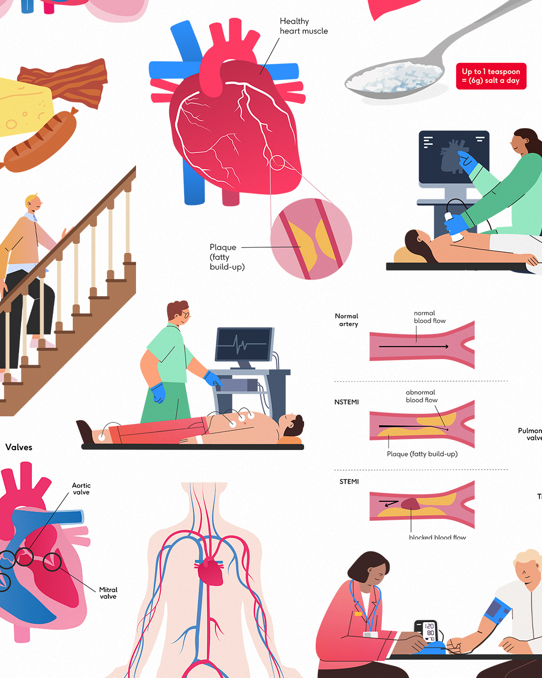 A medical infographic showing a heart attack and CPR scenes, with a large red heart, artery plaque diagrams and labels on a white background.