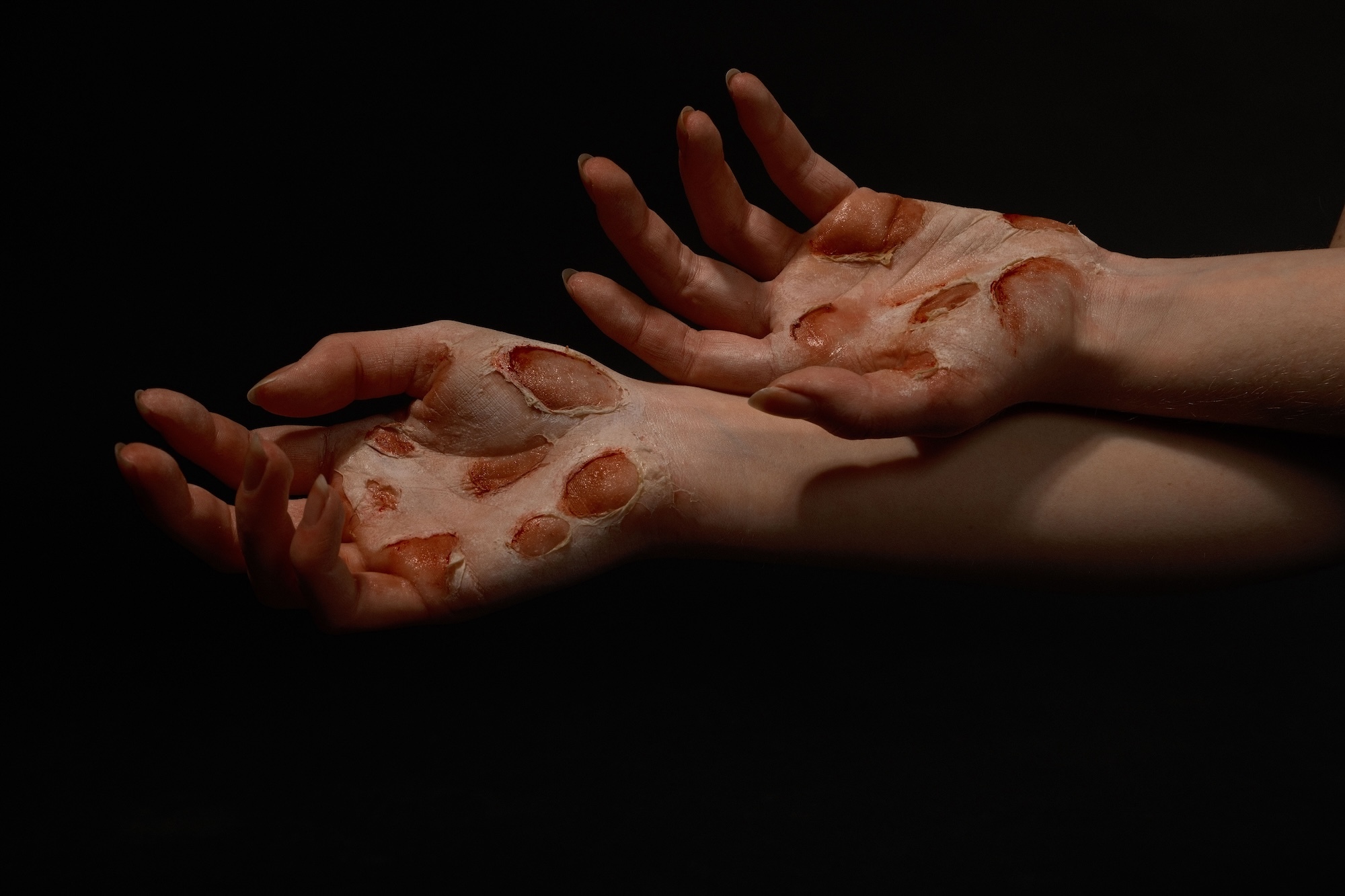 Close-up of a person's hands, showing several cuts or sores on their palms.