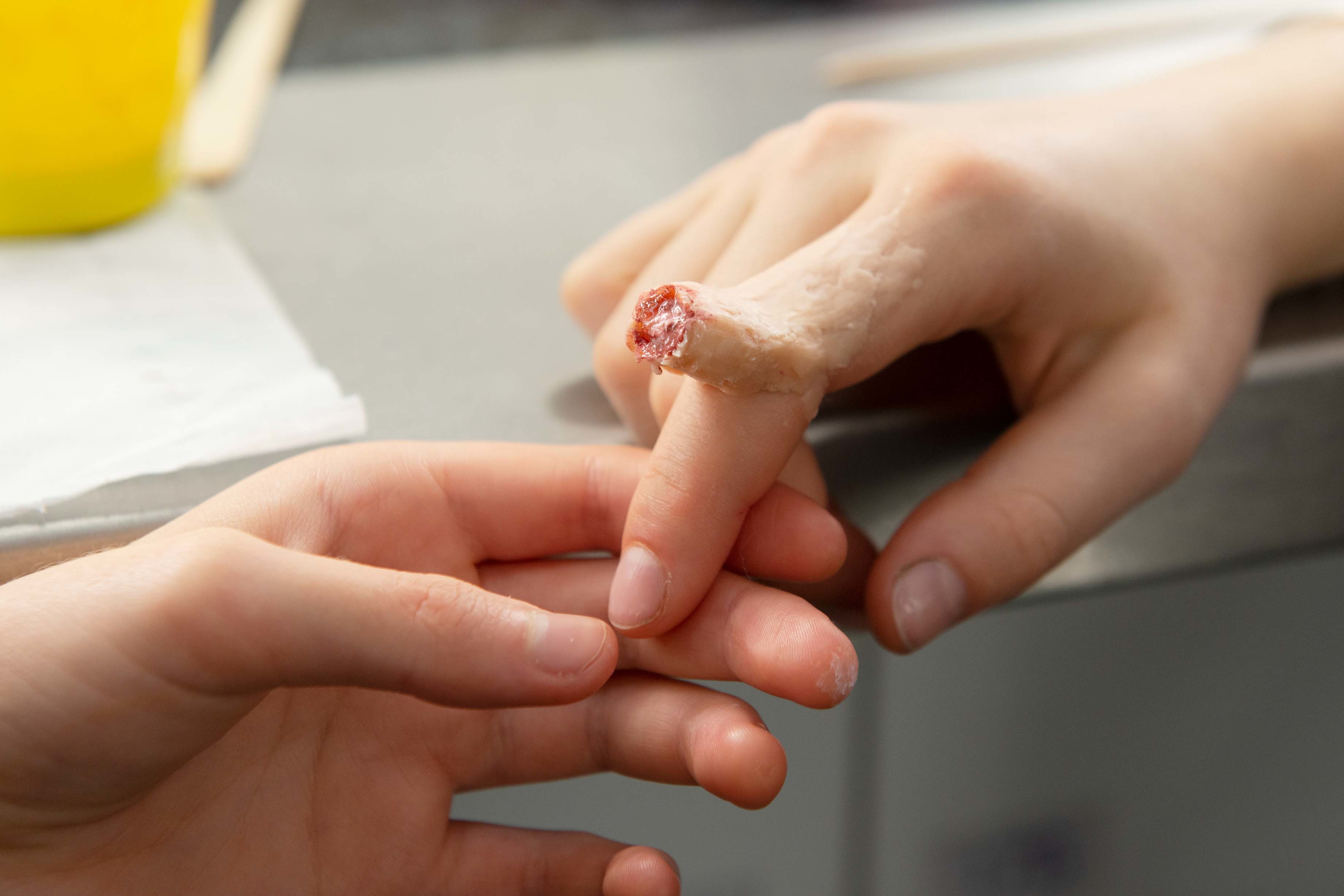 Hand with bleeding cut on finger being examined by another person's hands over grey surface with yellow object in background.