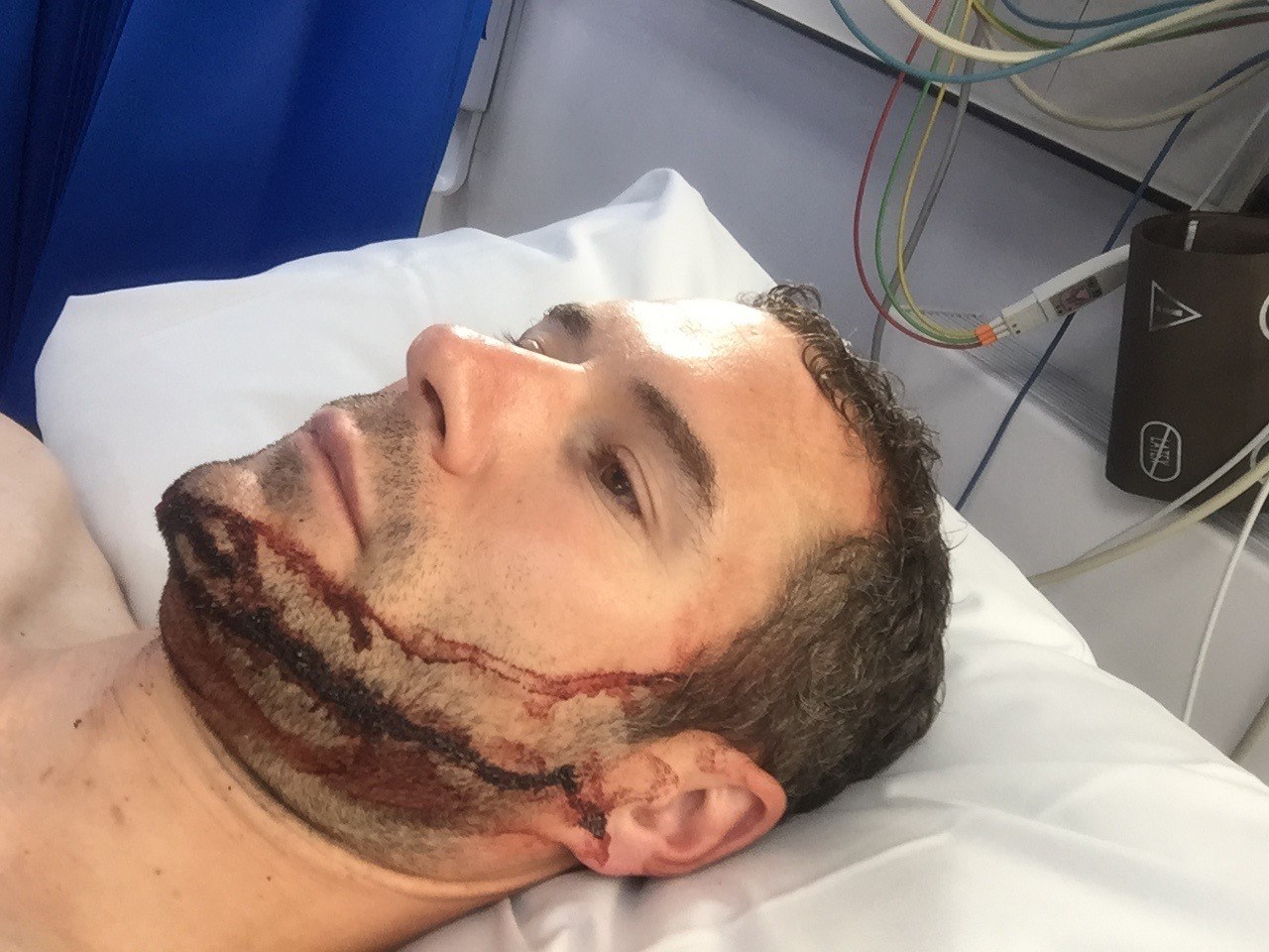 A man with a bloodied face lies in a hospital bed