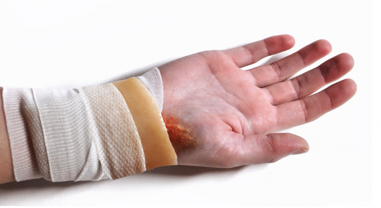Hand with a injury