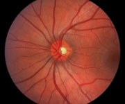 AMD pic eye