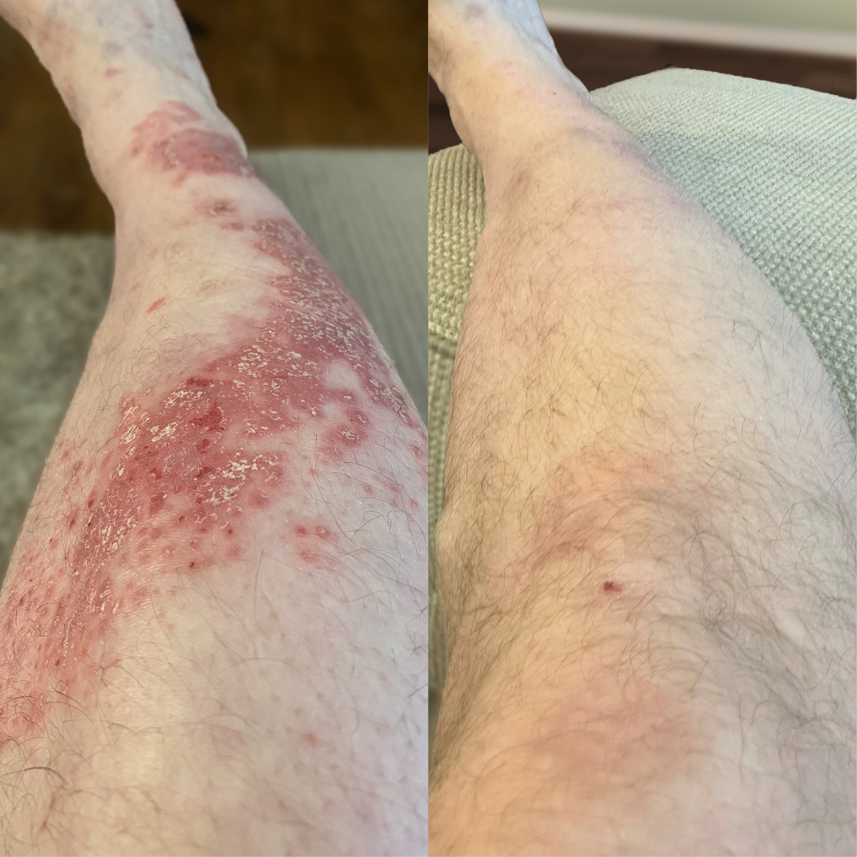 BMS3727 Sotyktu GP Article MJA psoriasis image 417x417px R0 2
