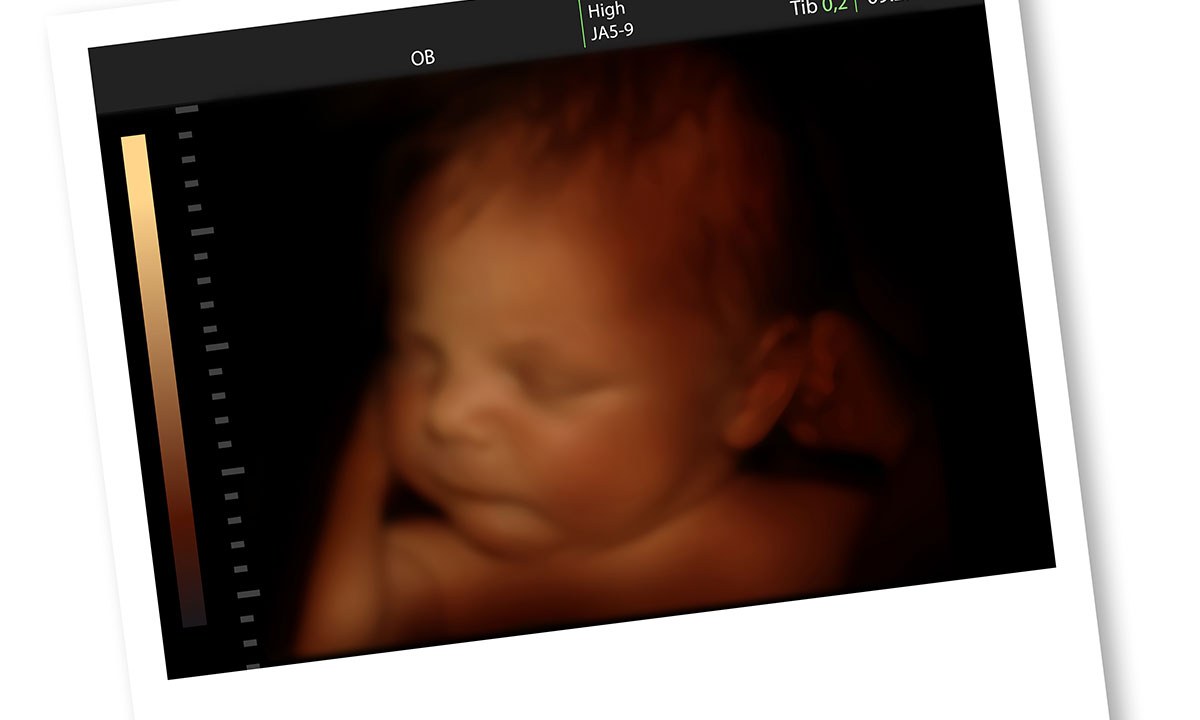 Stillbirth