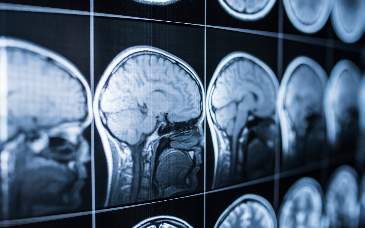 The burden of traumatic brain injuries - Featured Image