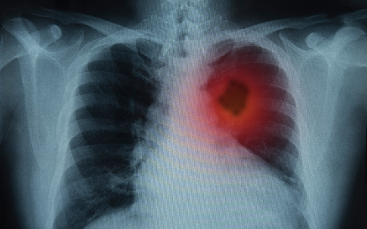 Lung Cancer Screening Program must be co-designed with Indigenous Australians - Featured Image