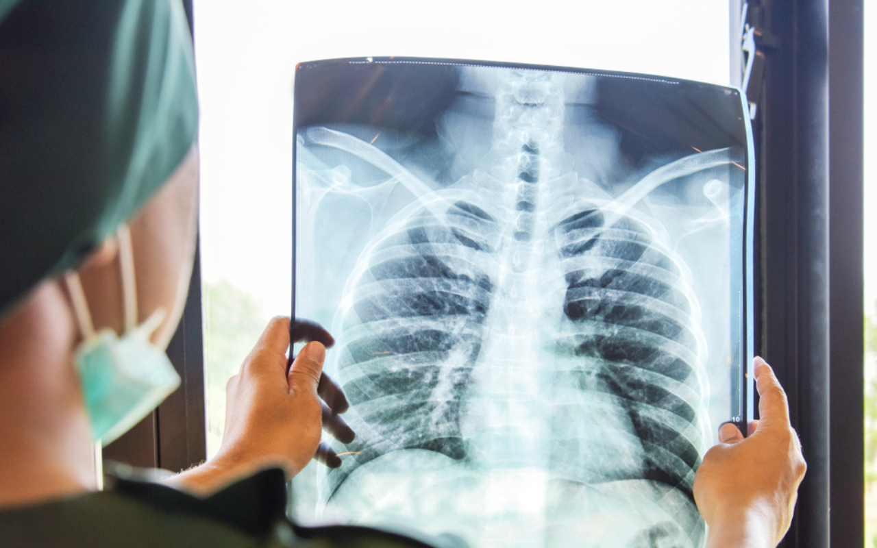 New guidelines for chronic lung disease   - Featured Image