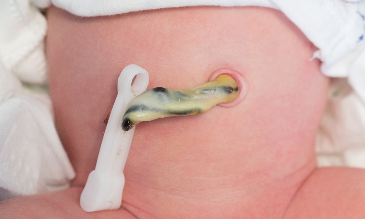 A knotty question: when to clamp the umbilical cord - Featured Image