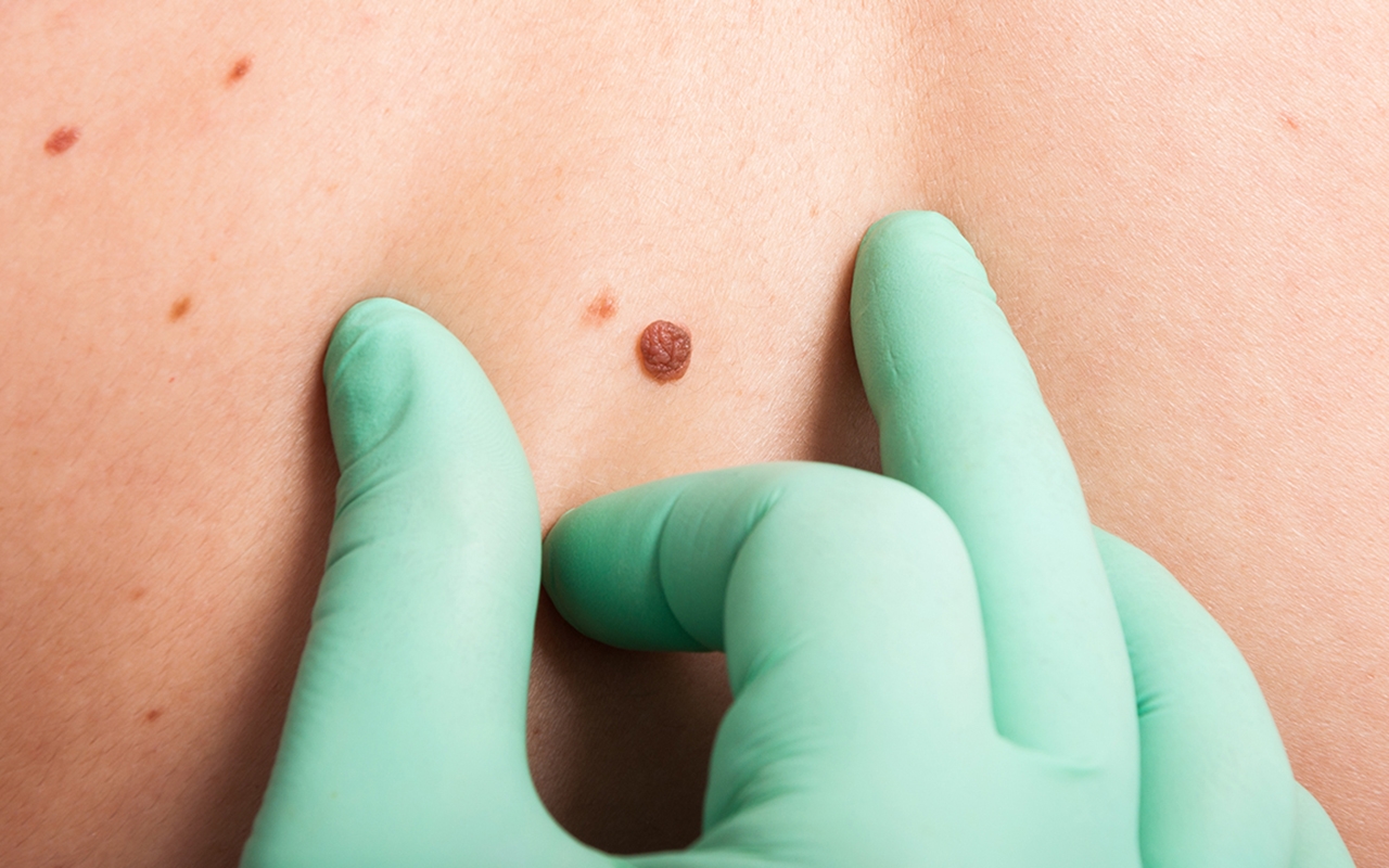 Accurate staging of melanomas: biopsy technique matters - Featured Image