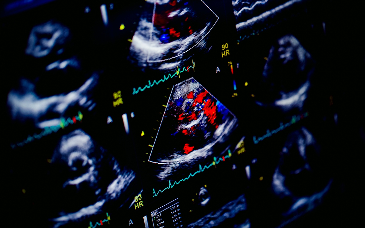 Active screening needed for rheumatic heart disease - Featured Image