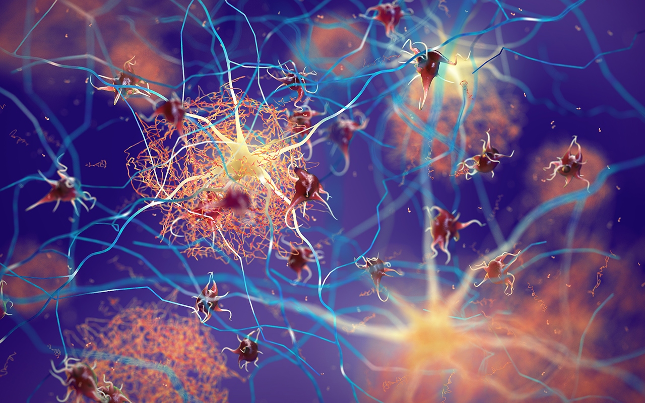 Aducanumab for Alzheimer disease: opinions mixed, cost “crazy” - Featured Image