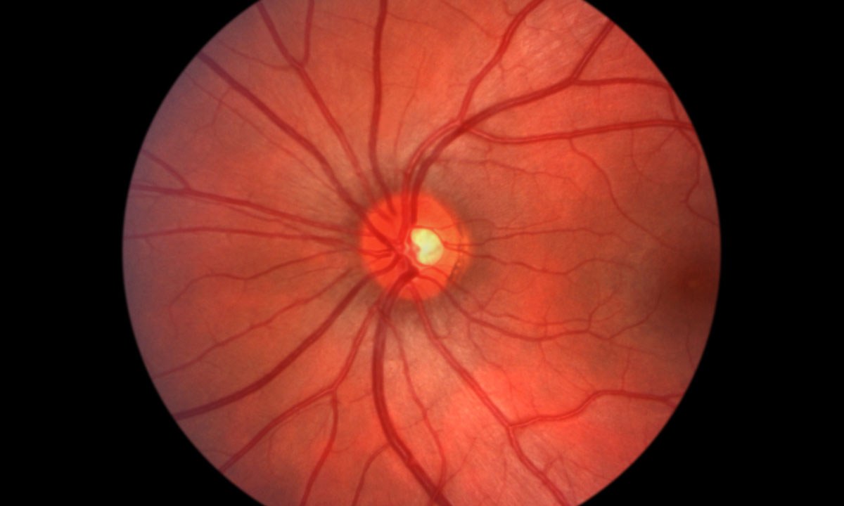 All eyes on age related macular degeneration 286