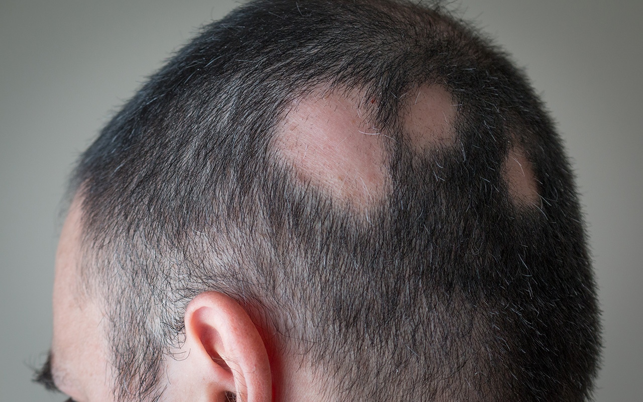 Alopecia new treatments give hope to patients 641