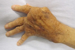 Some immunosuppressants may lower diabetes risk - Featured Image