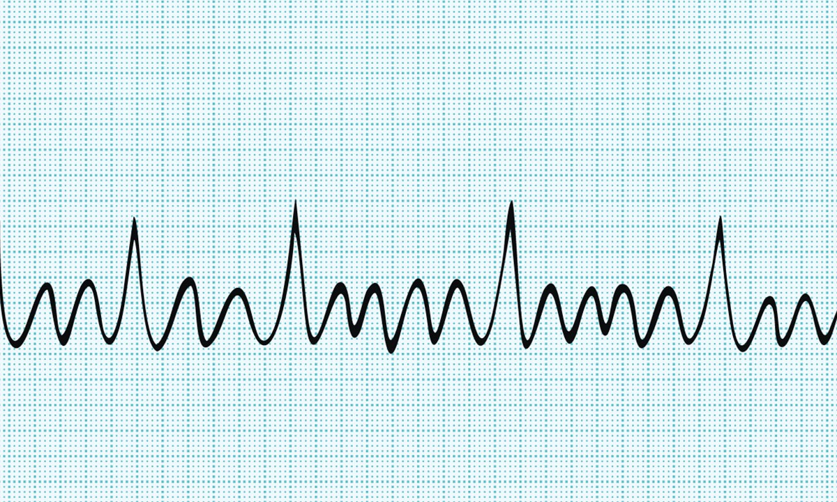 Picking the right patients for AF ablation - Featured Image