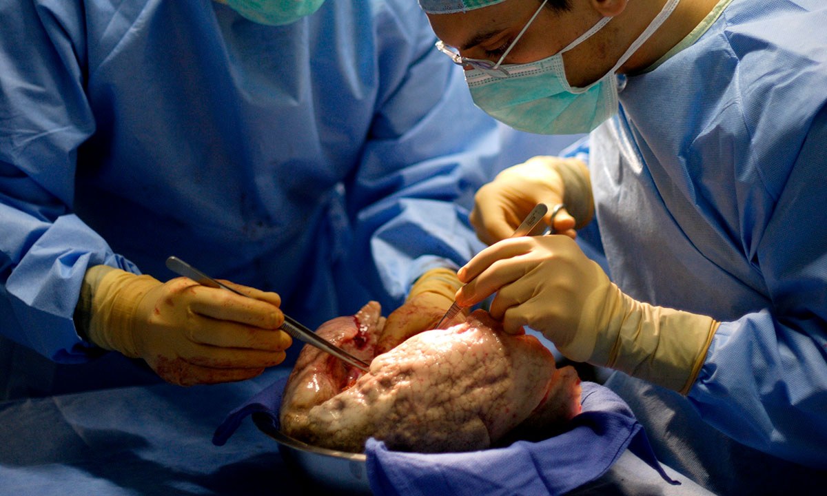 Australian lung transplants leading the world 541