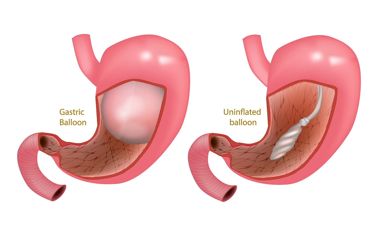 Bariatric endoscopy worth considering for obese patients - Featured Image