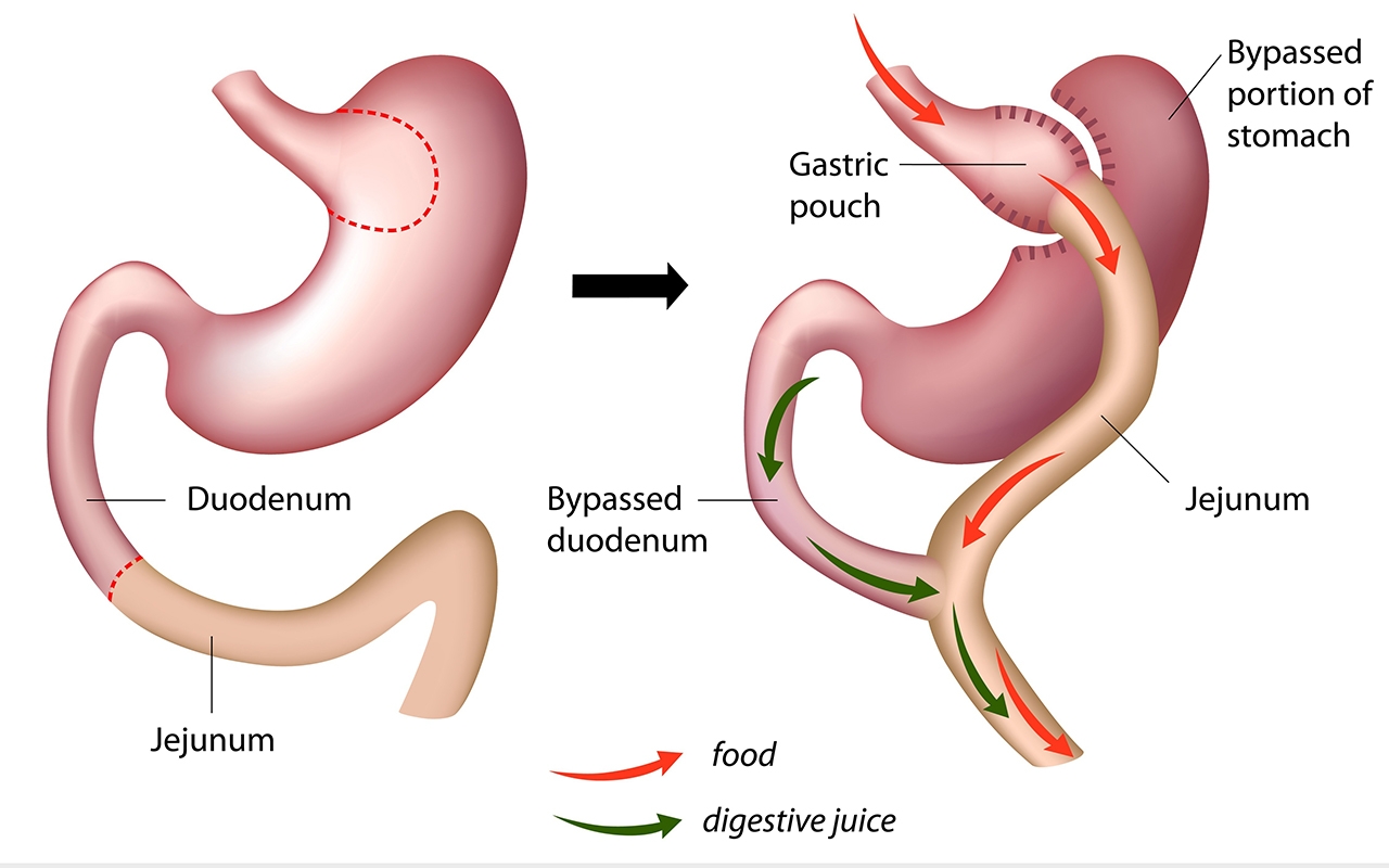 Bariatric surgery public system access still terrible 703
