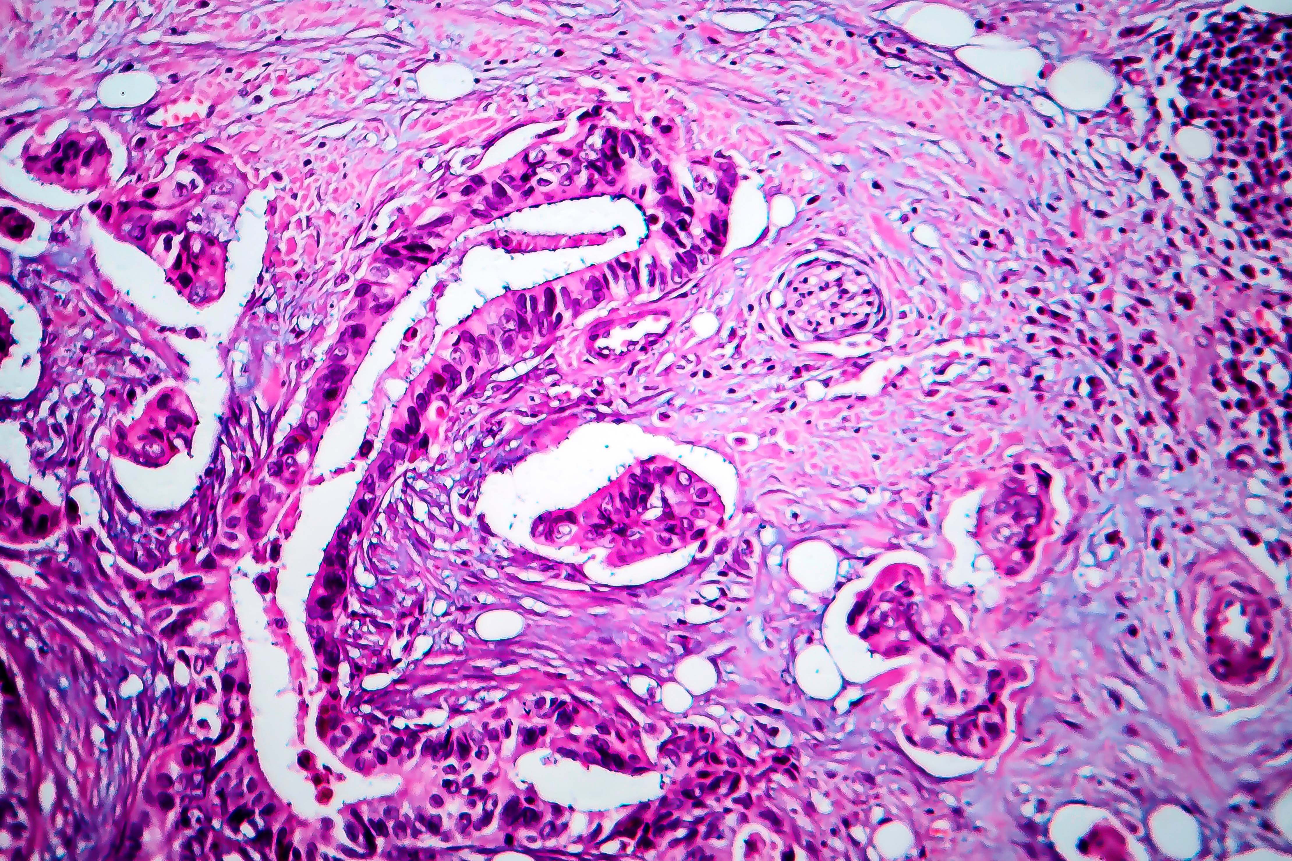 Breast cancer screening benefits outweigh overdiagnosis risks 493