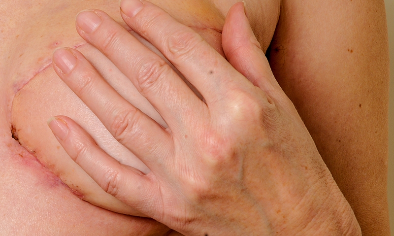 Low rates of breast reconstruction “shocking” - Featured Image