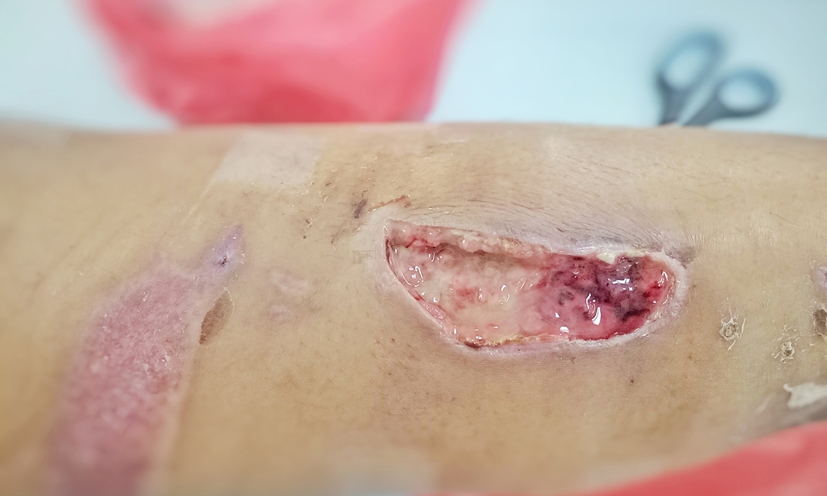 Buruli no ulceration do a punch biopsy 138