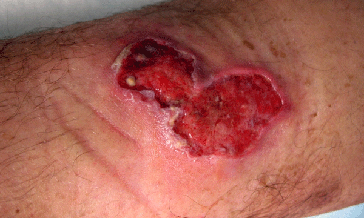 Buruli ulcer warning for gps 531