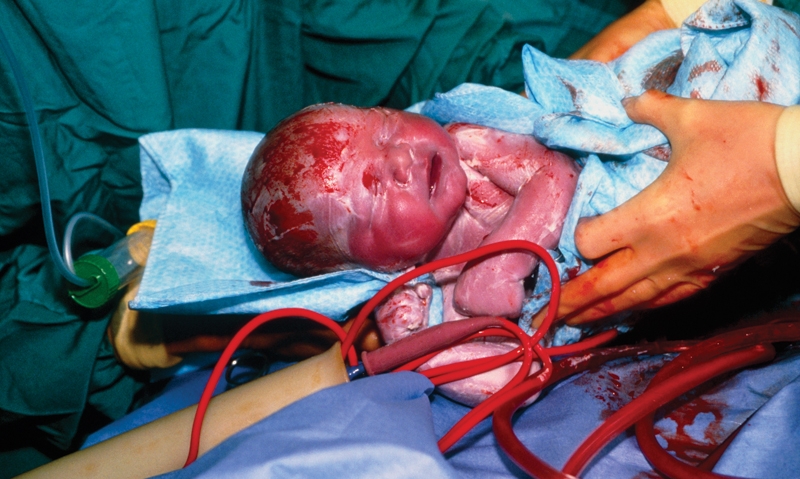 Anti-caesarean drive “misguided” - Featured Image