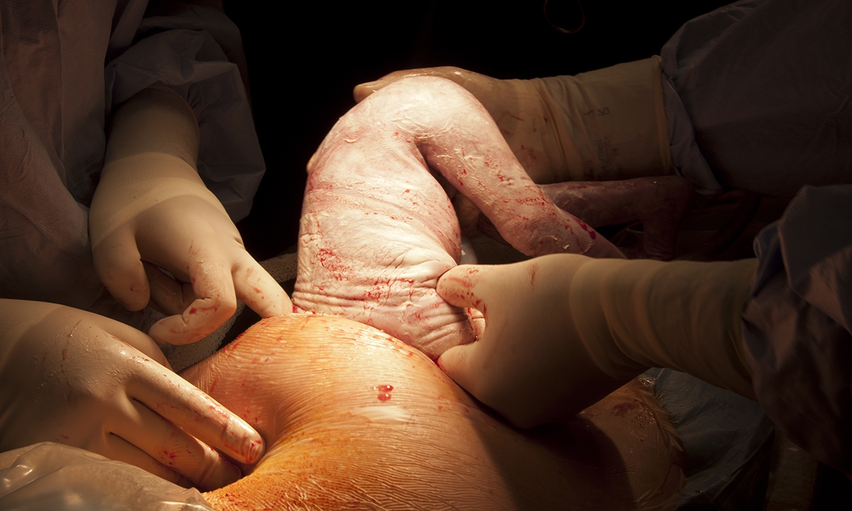 Caesareans according to need not who recommendations 521