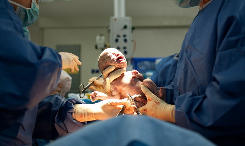 Caesarean target “too low” - Featured Image