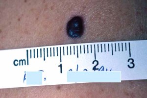 Tumour cells predict cancer survival - Featured Image