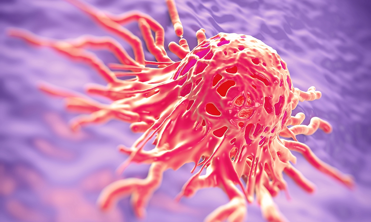 Cervical cancer1