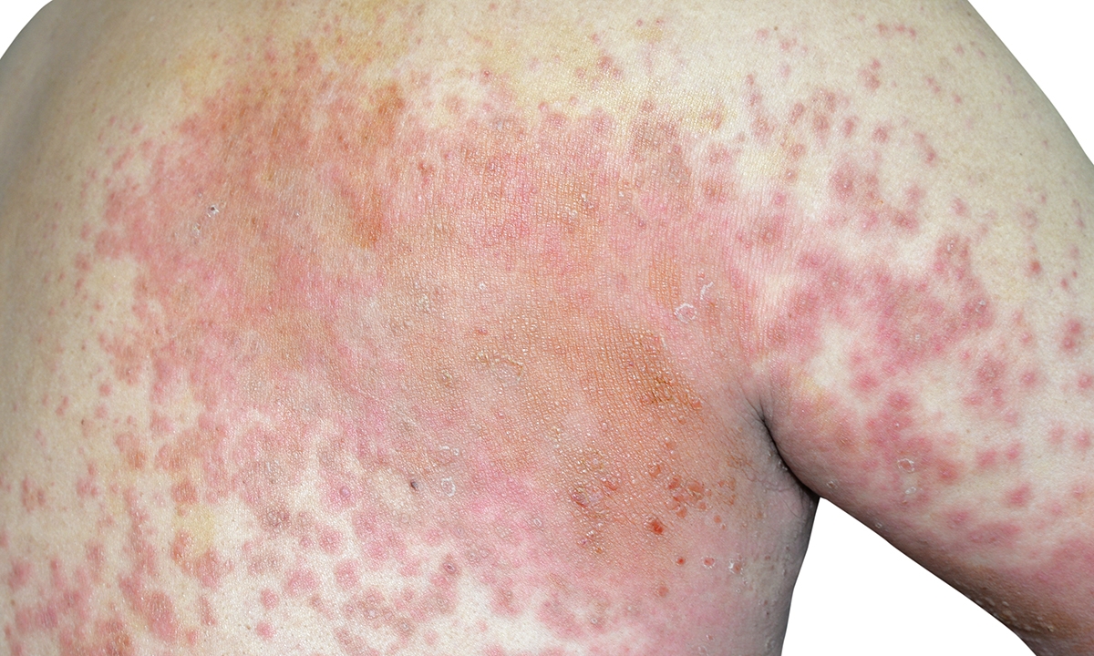 Coming revolution in atopic dermatitis - Featured Image