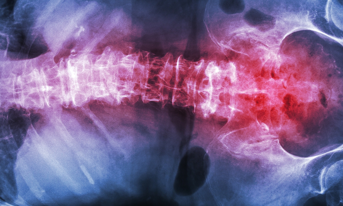 Consider ankylosing spondylitis 392