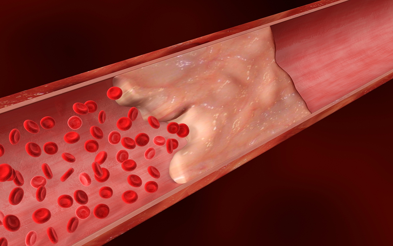 Coronary artery calcium scoring when we should use it 718