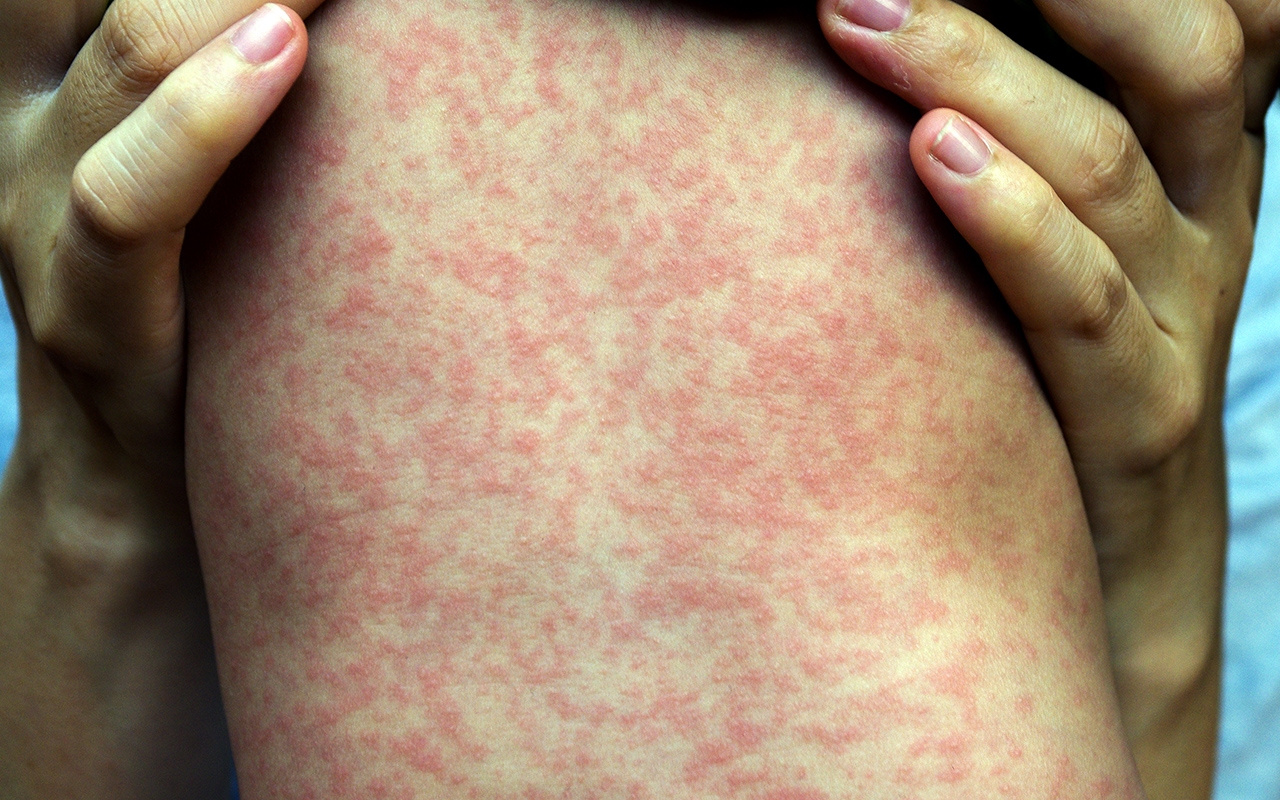Covid 19 lockdown suppresses measles but beware the return 134