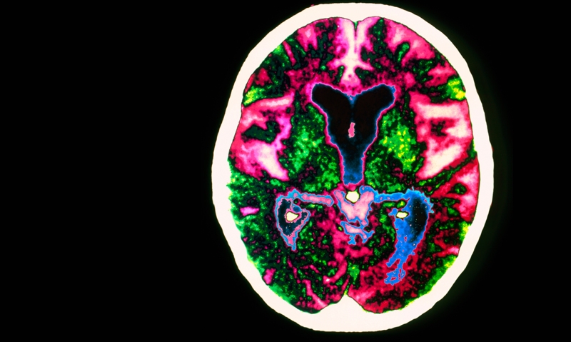 Concern over Indigenous dementia - Featured Image