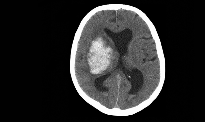 Centralised stroke care “key” - Featured Image