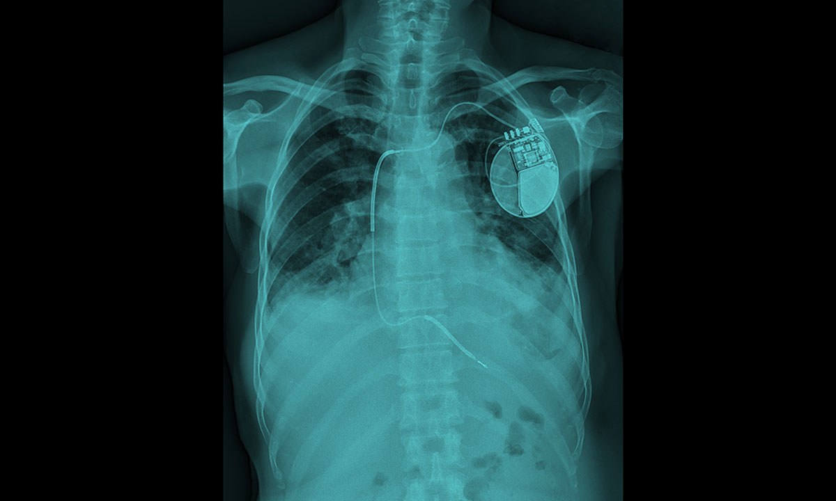 Defibrillators in the oldest patients wheres the benefit 407