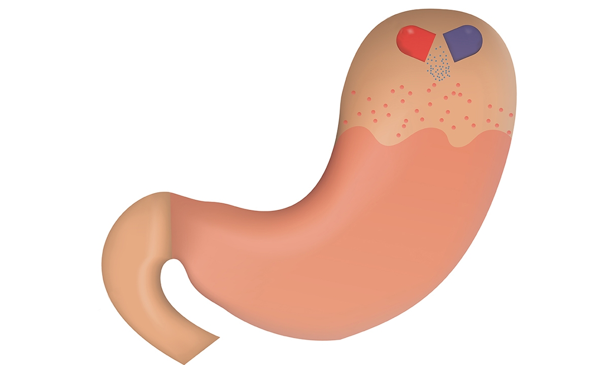 Deprescribing PPIs “worthy”, but benefits outweigh risks - Featured Image