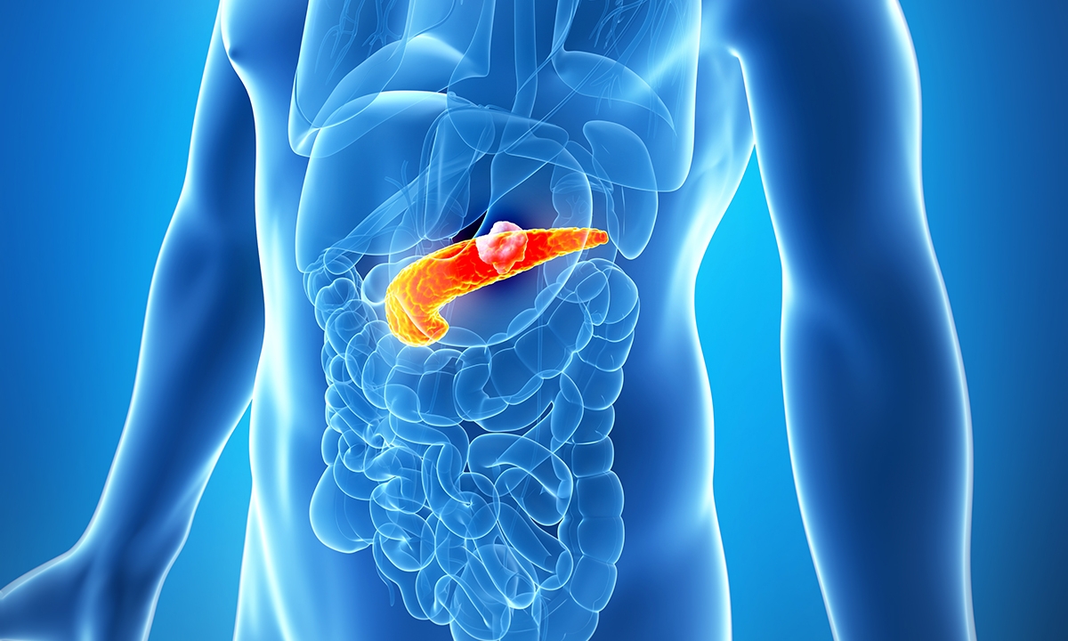 Disturbing inequities in pancreatic cancer care 895