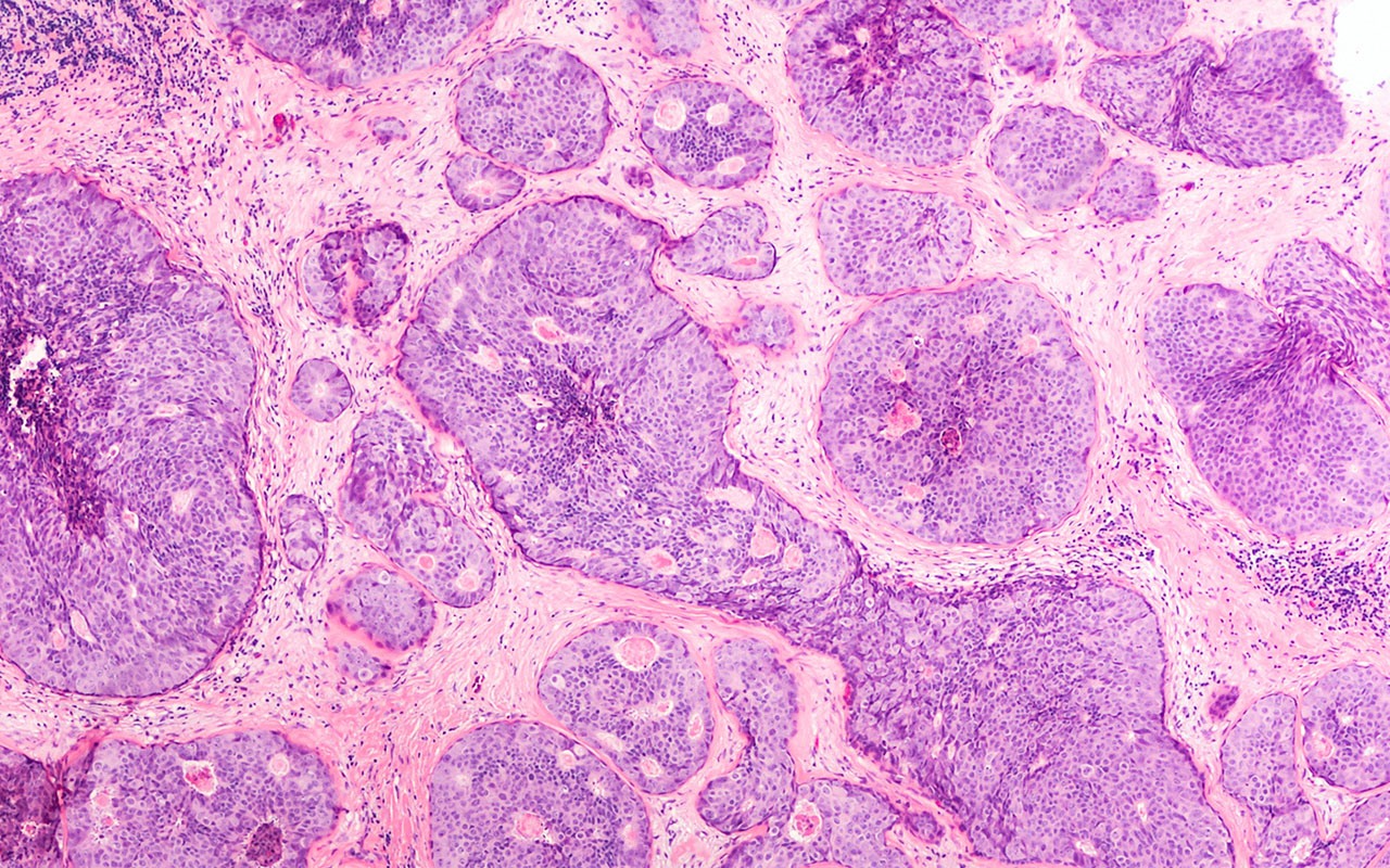Drop in cancer pathology: is there a surge in cases coming? - Featured Image