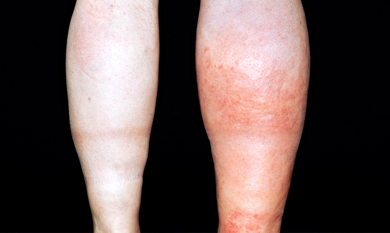 Who needs VTE prophylaxis? - Featured Image
