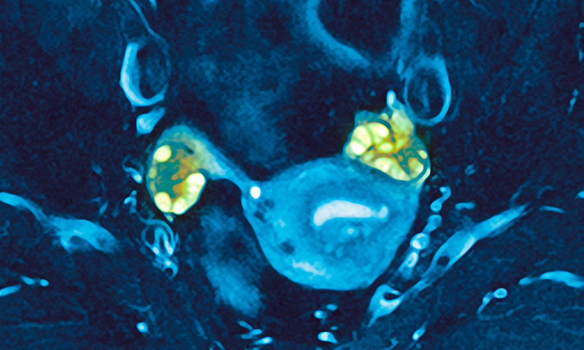 Focus on weight with polycystic ovary syndrome 643