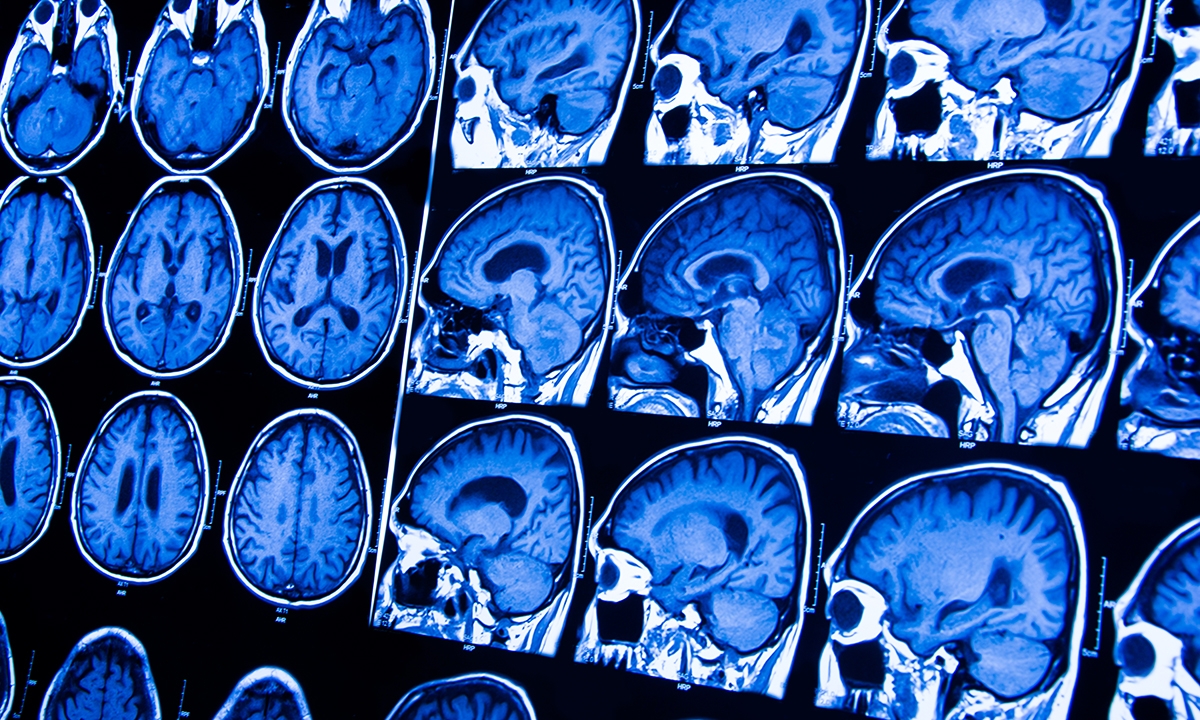 Frontotemporal dementias: treat the symptoms, spare the carers - Featured Image