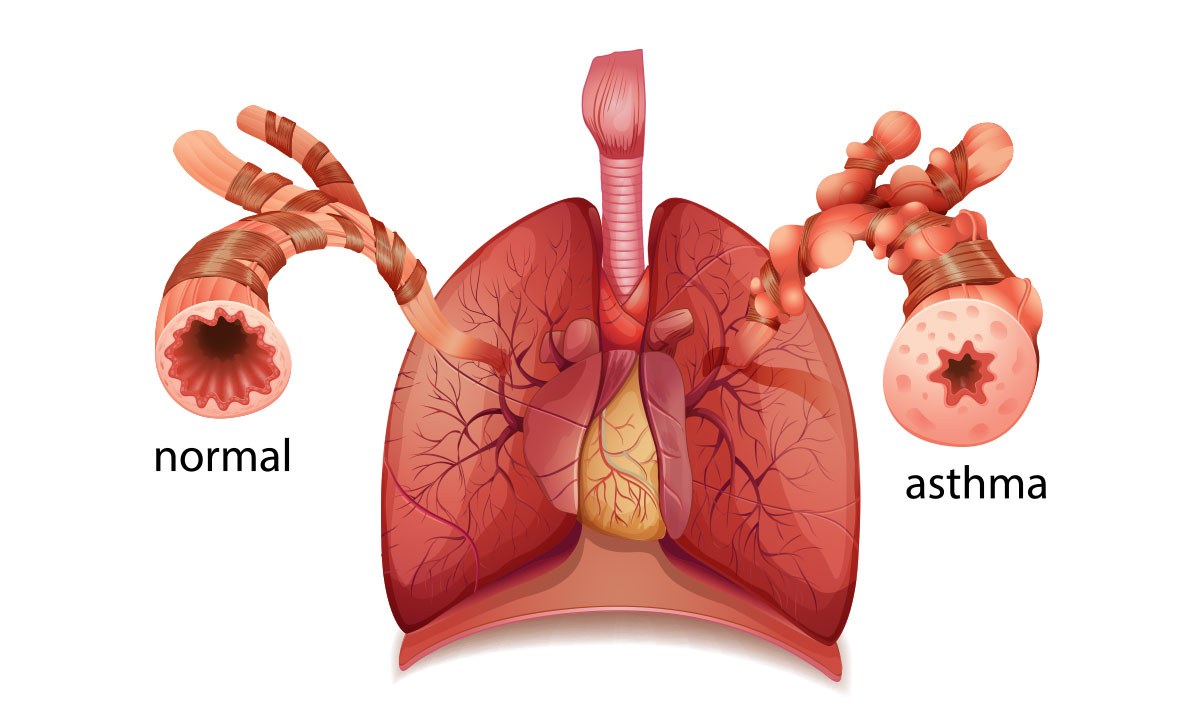 Game-changing therapy for severe asthma - Featured Image