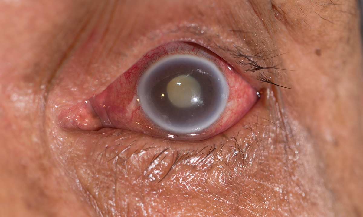 Glaucoma the sneak thief of sight 603