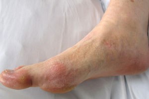 Gout large