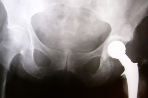 Hip large