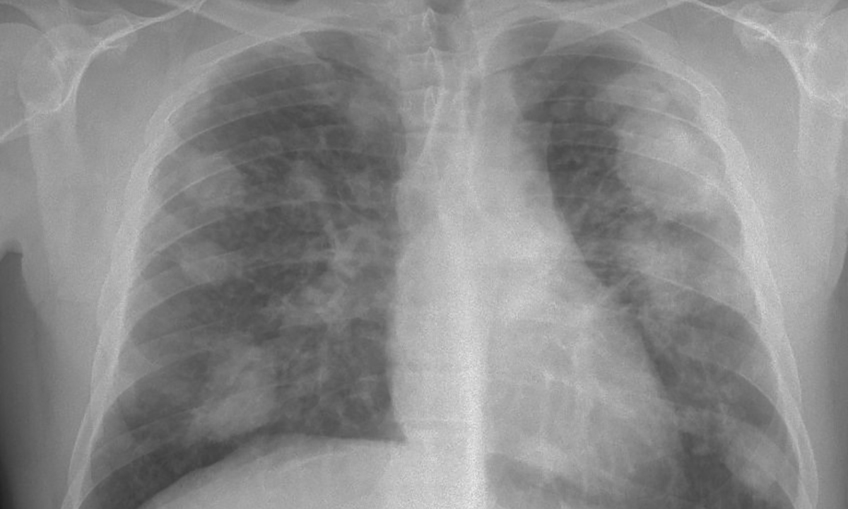 How climate change can spread respiratory infection - Featured Image